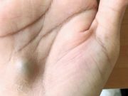 Tento muž po návštěvě zubaře málem přišel o život. Pokud se Vám na dlani udělá tato výduť, okamžitě volejte záchranku!