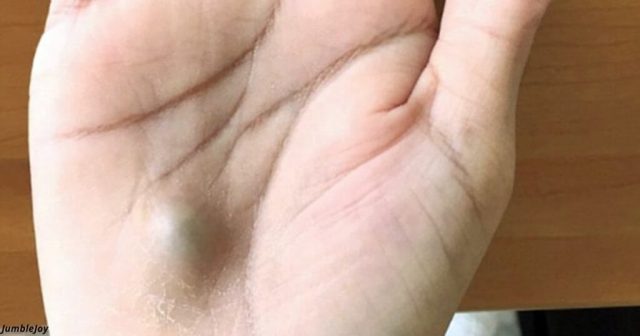 aneurysma